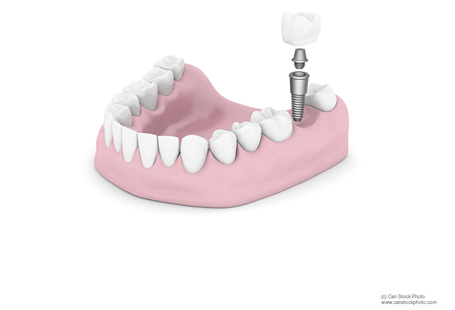 Dental Implant