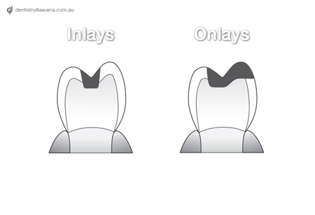 Fillings Inlays-Onlays