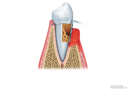 Periodontal Treatment