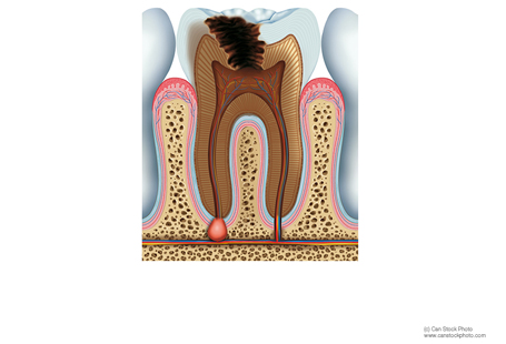 Root Canal