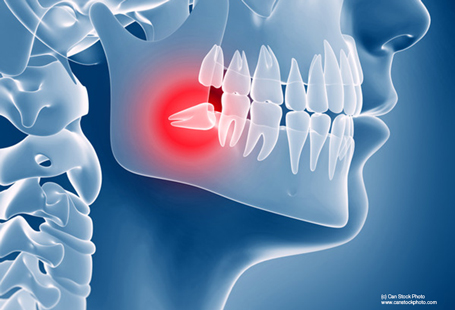 Wisdom Tooth